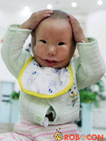 Bé trai Huikang sinh ra với dị tật hiếm gặp