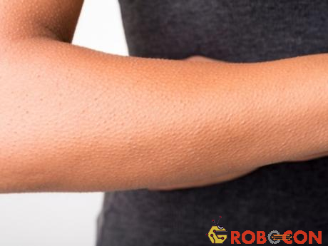 Nổi da gà thường rõ nhất ở cánh tay, có khi xuất hiện ở trên mặt