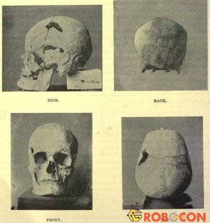 Hộp sọ thuộc hài cốt pharaoh Sa-Nakht. 