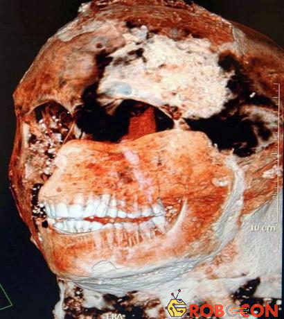 Một hình ảnh quét CAT cho thấy hàm răng của người La Mã cổ đại cực kỳ khỏe mạnh.