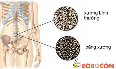 Khi cơ thể thiếu vitamin K sẽ hạn chế quá trình chuyển hóa canxi nên dễ dẫn đến tình trạng loãng xương.