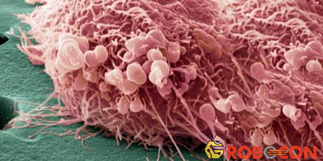 Tế bào ung thư vú ở phụ nữ.
