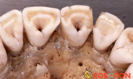 Răng sữa hình xẻng đặc trưng của thổ dân châu Mỹ và người Đông Á.