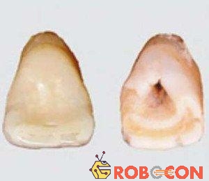 Răng sữa bình thường (trái) và răng sữa hình xẻng (phải).