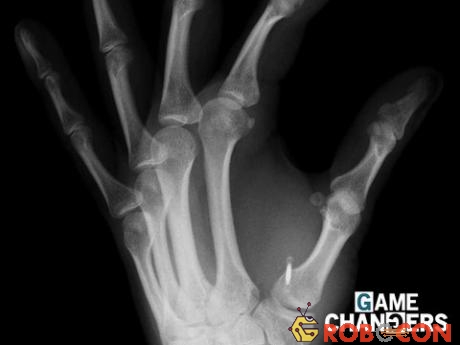 Ảnh chụp X-quang một bàn tay với microchip nằm giữa ngón trỏ và ngón cái