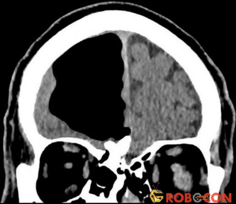 Hình ảnh chụp CT não của cụ ông cho thấy có lỗ hổng trống không.