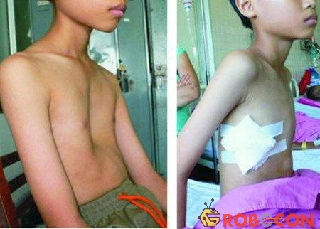 Bệnh nhân trước và sau phẫu thuật lõm ngực.