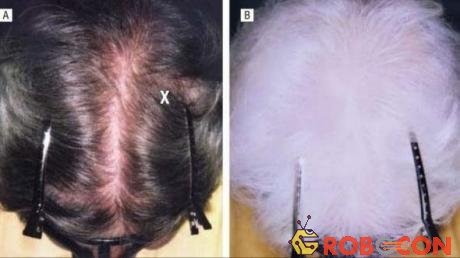 Một bệnh nhân bị canities subita khiến tóc bạc trong 6 tháng.
