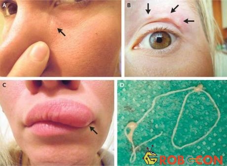 Người phụ nữ Nga nhận ra trên mặt mình có mọc một cục u rất nhỏ, tại phần mũi ngay dưới mí mắt.