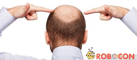 Những người hói đầu thường mất đi khả năng bảo vệ da đầu