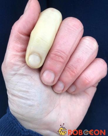 Hình ảnh ngón tay trắng bệch do bệnh Raynaud. 