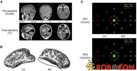 Ảnh chụp fMRI cho thấy U.D. bị khiếm khuyết mất 1/3 bán cầu não phải.