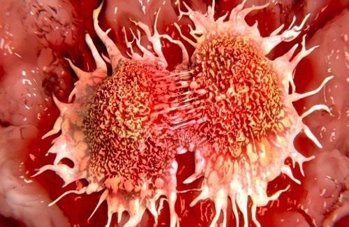 Các nhà khoa học Nga và Thụy Điển tìm ra cách diệt tế bào ung thư