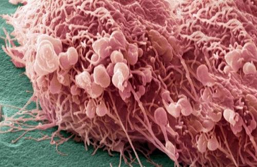 Đã tìm ra nguyên nhân hình thành tế bào ung thư di căn
