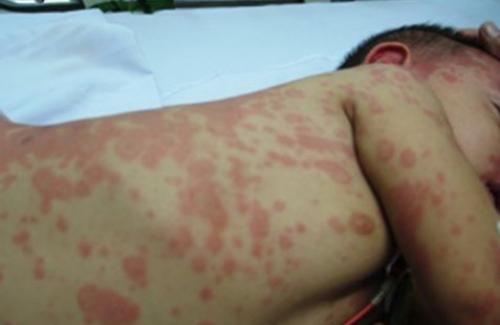 Sự nguy hiểm của bệnh sốt xuất huyết và cách phòng bệnh Sốt xuất huyết