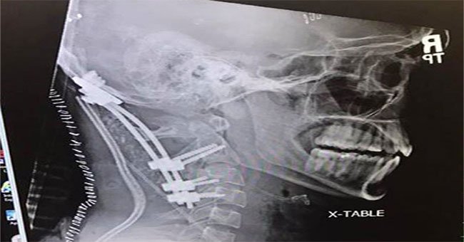 Chàng trai 22 tuổi gây chấn động y học vì sống sót sau tai nạn "suýt rụng đầu"
