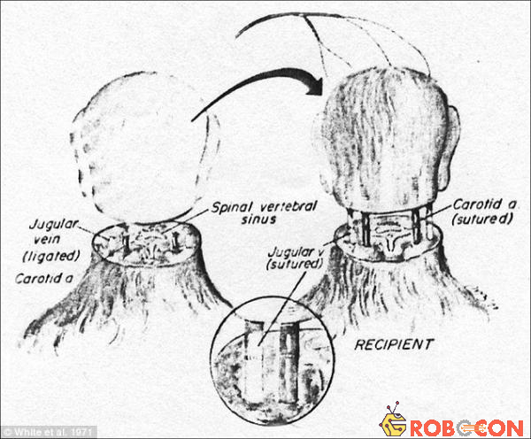 Ca phẫu thuật ghép đầu người đầu tiên trong lịch sử