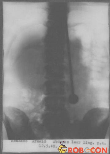 Ảnh chụp X-quang vào ngày 12 tháng 5 năm 1948 cho thấy một cây kim đang nằm gọn trong bụng Dajo.